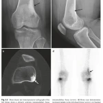Sách Oncologic Imaging Bone Tumors