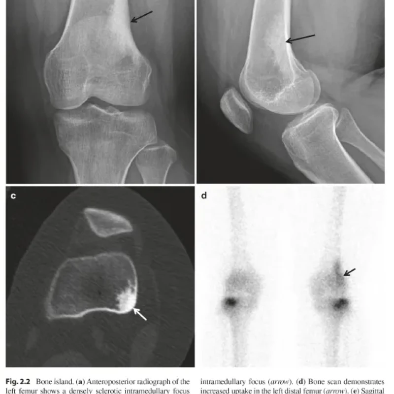 Sách Oncologic Imaging Bone Tumors