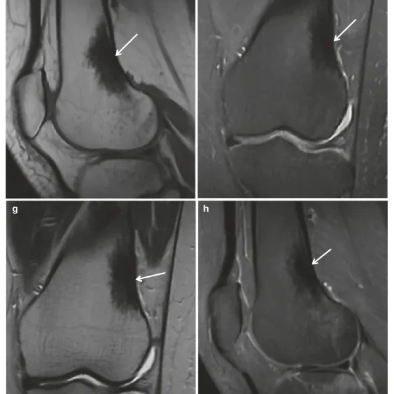 Sách Oncologic Imaging Bone Tumors