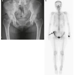 Sách Oncologic Imaging Bone Tumors